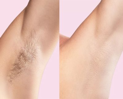 Beforea-and-after-laser-hair-removal